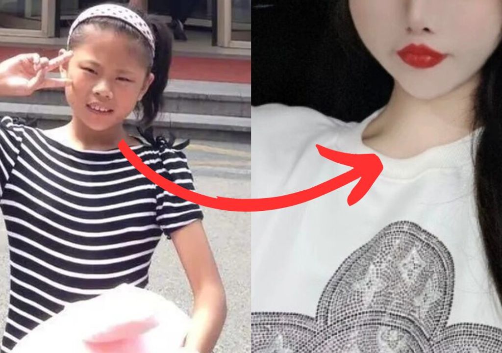 A polêmica decisão de permitir que uma menina de 13 anos fizesse plástica